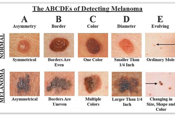 Mole or Blemis Clinic @ NMP