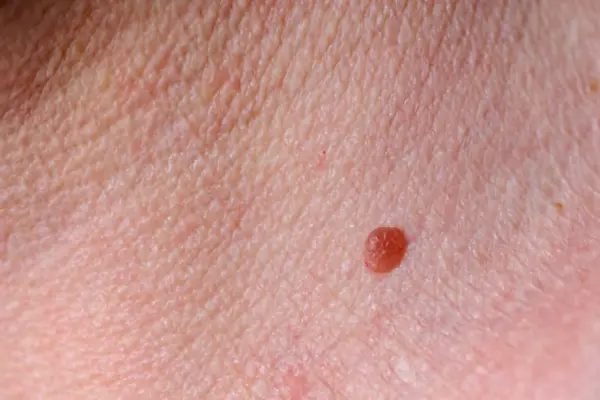 Mole or Skin Blemish Clinic